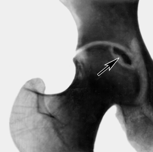 osteonekr