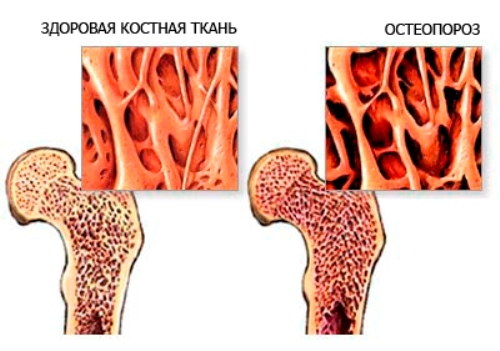 osteop-sb