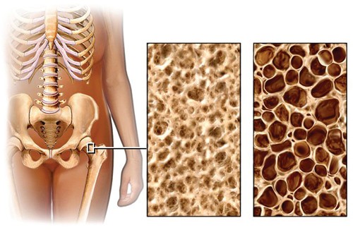 osteop1