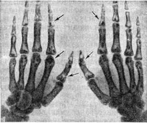 osteopoik