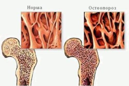 osteoporoz