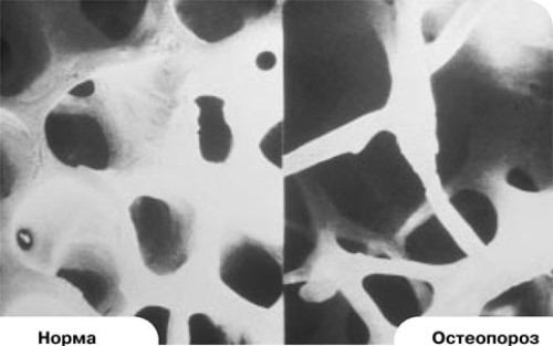 osteoporoz