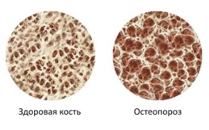 osteoporoz1
