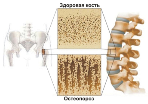 osteoporoz2