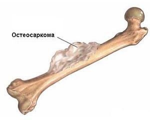 osteosar