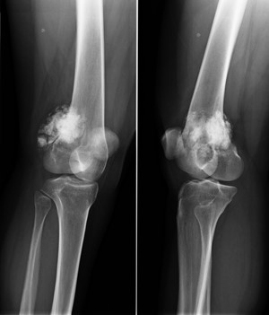 osteosar2