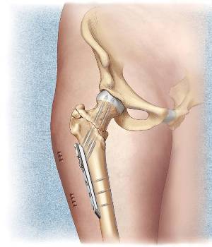 osteosin2