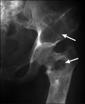osteoskl
