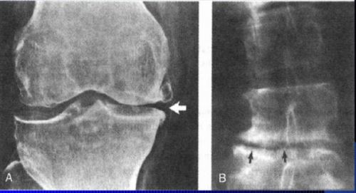 osteoskl2