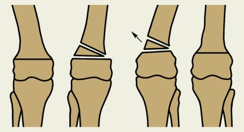 osteotomia