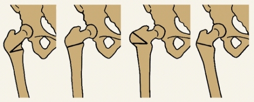 osteotomia2