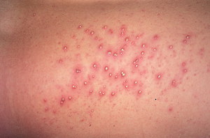 pioderm