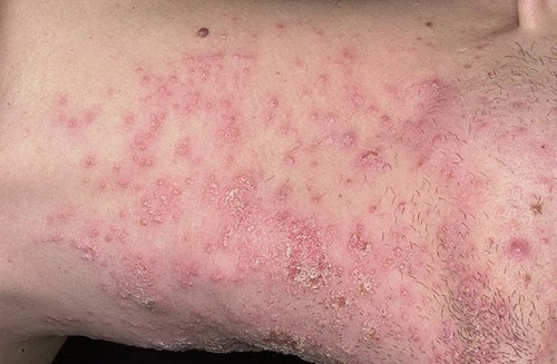 pioderm2
