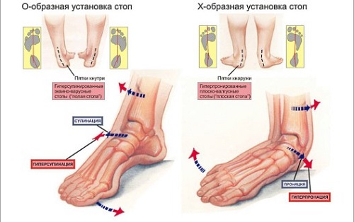 ploskostopie-2(1)