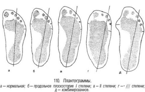 ploskostopie02