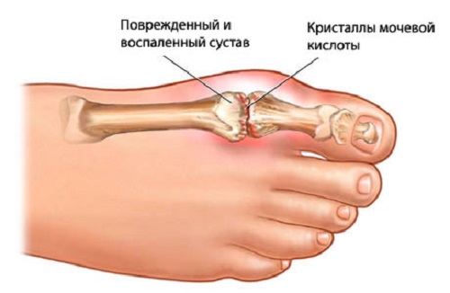 podagra1