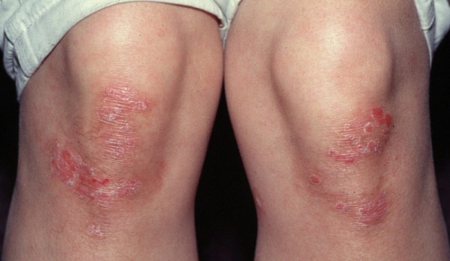 psoriaz