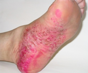psoriaz2