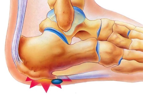 pyat-shpora-simptomy-i-lechenie-1