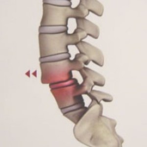 spondilolis2