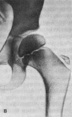 tuberkul2