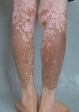 vitiligo