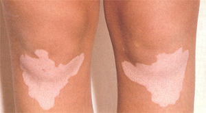 vitiligo3